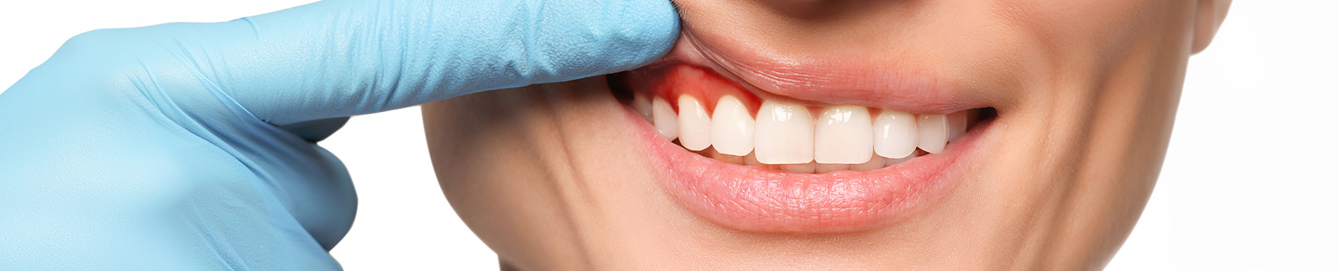 A person with a dental hygiene device in their mouth, likely a dental mirror or probe, being used by a professional wearing gloves and a mask.