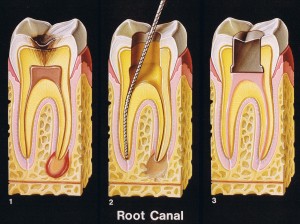 The image displays a medical illustration showing a series of cross-sections through a tooth, depicting its internal structure with dental roots, pulp chamber, and root canal system.