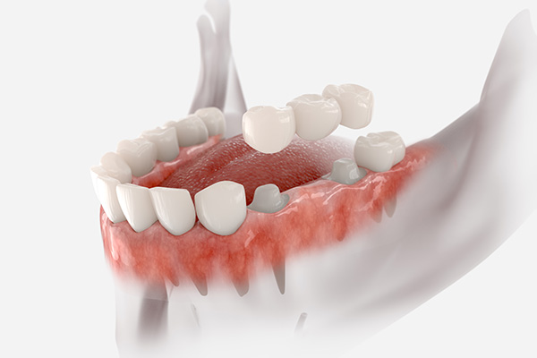 The image shows a 3D rendering of an open human mouth with teeth and gums, displaying a detailed view of dental structures and possibly used for educational or medical purposes.