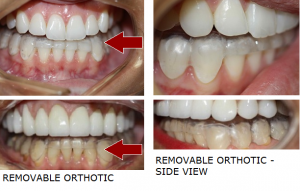The image shows a before-and-after comparison of an orthodontic treatment, with the top part displaying a crooked smile and the bottom part showing a straightened smile after removal of braces.