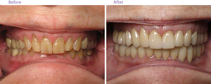 The image shows two side-by-side photographs of a person's teeth before and after dental treatment, highlighting an improvement in oral hygiene through cosmetic dentistry.