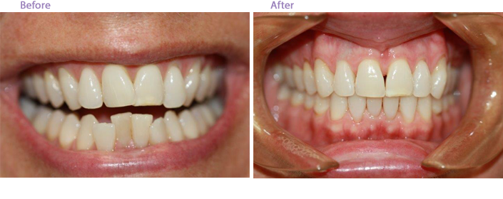 The image displays a side-by-side comparison of a person's teeth before and after dental treatment, with the 'before' side showing teeth with visible staining and the 'after' side showing clean, white teeth.