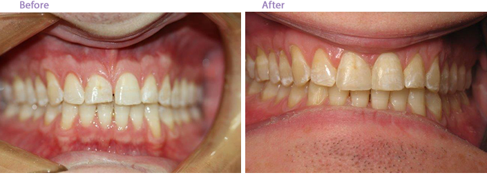 This image shows two side-by-side photos of a person's teeth before and after dental treatment, highlighting the transformation from yellowed teeth with visible stains to cleaner, whiter teeth.