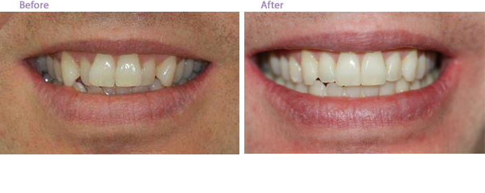 The image shows two side-by-side photographs of an individual's smile before and after dental treatment, highlighting improved oral health and cosmetic enhancement.
