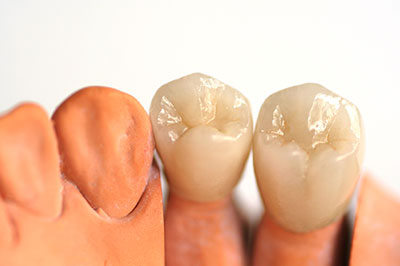 The image shows three artificial teeth with varying shades of yellow, placed side by side against a white background.