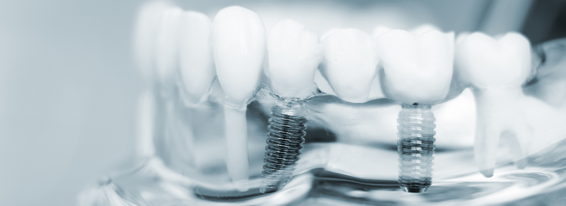 The image shows a close-up view of multiple teeth with visible braces, set against a blurred background.